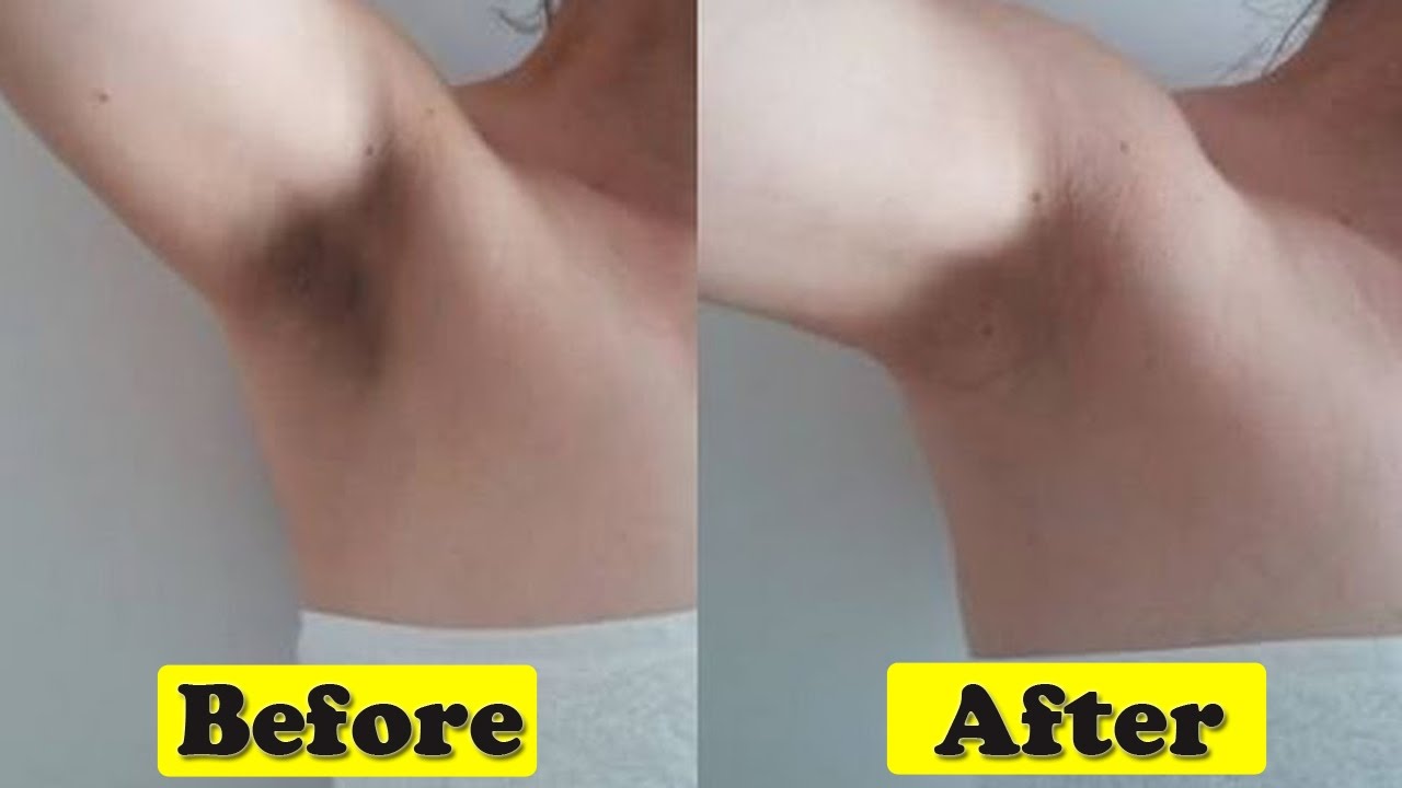 Tips To Get Lighten Dark Underarms