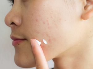 Acne Scars