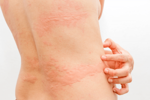 Skin Rashes