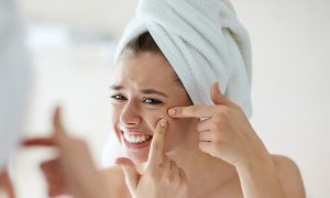 Treating Acne