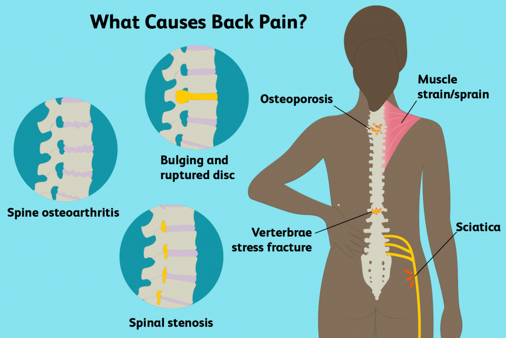 Causes of Back Pain