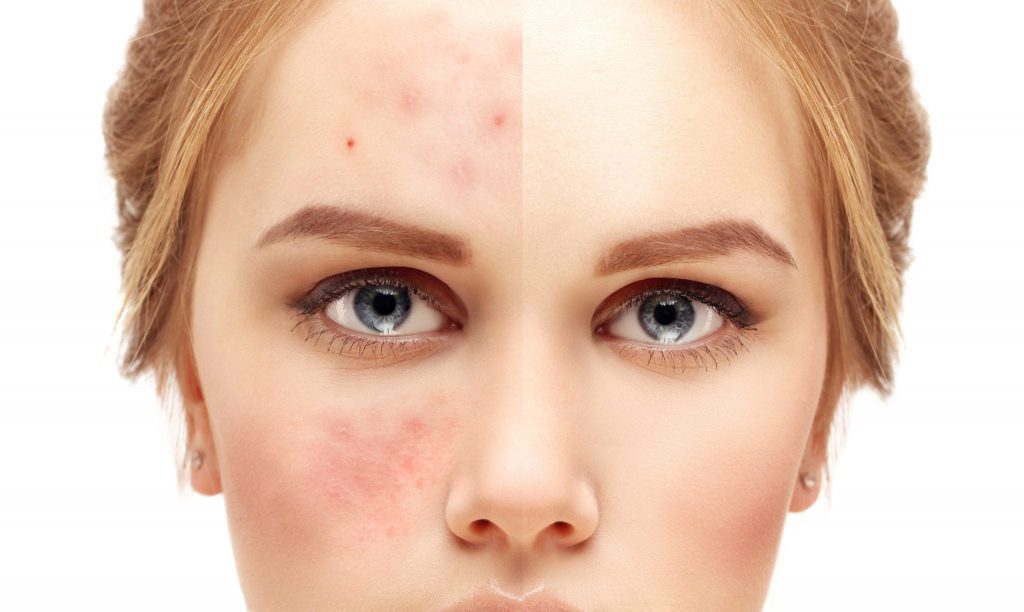 Acne Care Tips For Teenage