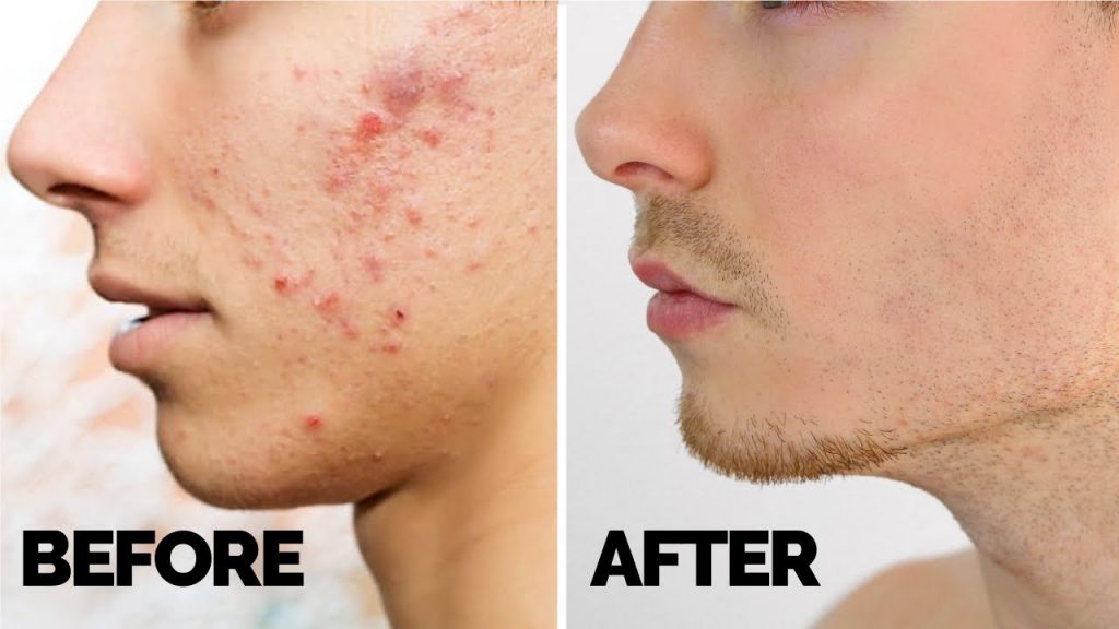 Acne Care Tips for Boys