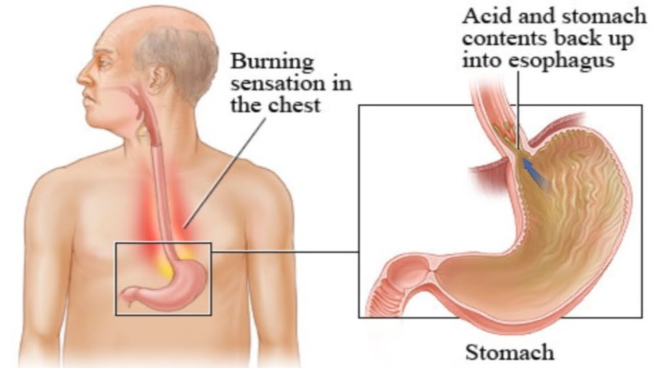 acid reflux symptoms