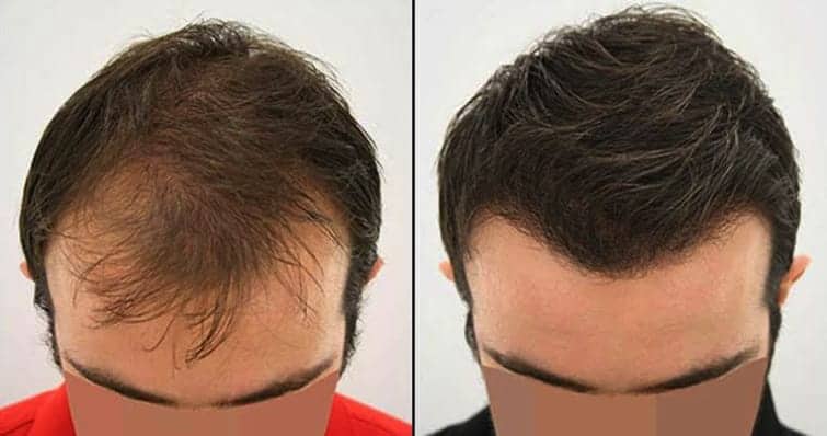 Hair Transplant Clinic